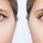Droopy Eyelid Surgery: Restore a Youthful & Alert Appearance