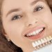 Porcelain dental veneers