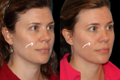 sculptra in dubai
